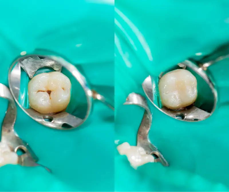 bonded fillings 1 tooth