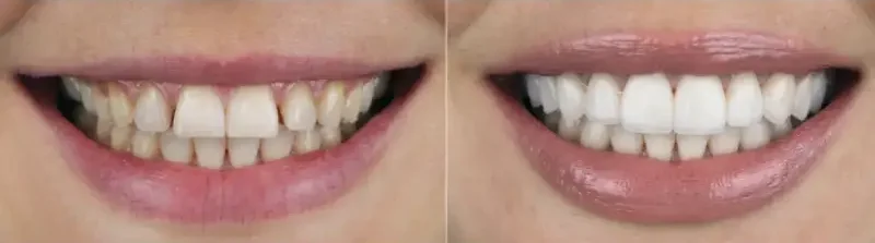 cosmetic contouring before after smile