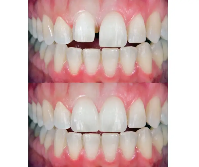 cosmetic contouring before after smile front tooth